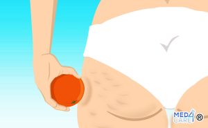 Scopri di più sull'articolo Cellulite