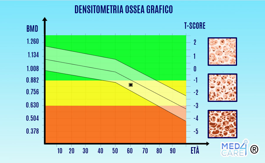 densitometria ossea grafico, interpretazione dei valori con T-score e Z-score