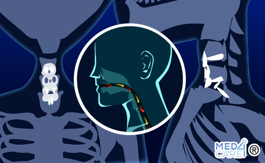 Disfagia postoperatoria e chirurgia del rachide cervicale anteriore