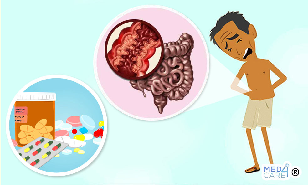 FANS e malattia di Crohn, morbo di Crohn