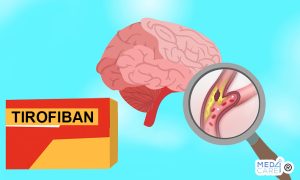 Scopri di più sull'articolo Il Tirofiban può migliorare gli esiti di ictus nei pazienti senza occlusione dei grandi vasi cerebrali?