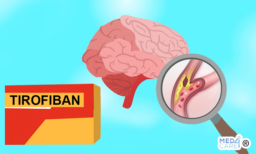 Tirofiban e ictus ischemico