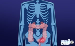 Scopri di più sull'articolo Calprotectina: il principale indicatore di infiammazione intestinale