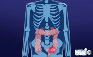 Scopri di più sull'articolo Calprotectina: il principale indicatore di infiammazione intestinale