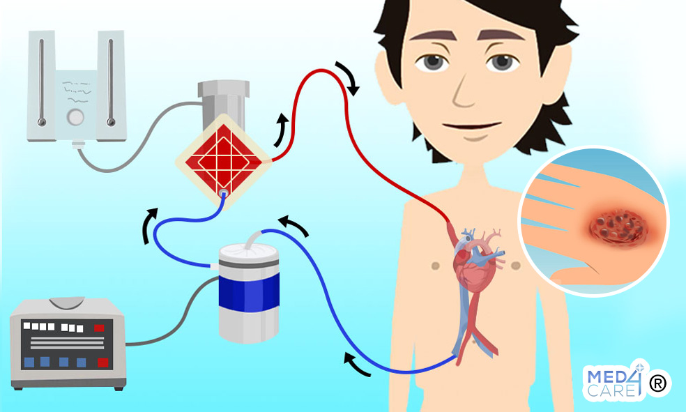 Circolazione extracorporea e chirurgia delle ustioni, bypass cardiopolmonare