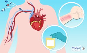 Scopri di più sull'articolo Trasfusione di piastrine prima del posizionamento di un CVC in pazienti con trombocitopenia