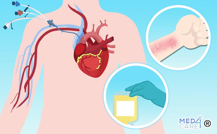 Trasfusione di piastrine prima del posizionamento di un CVC nei pazienti con trombocitopenia