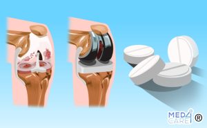 Scopri di più sull'articolo L’aspirina è un buon agente di tromboprofilassi per l’intervento di revisione di artroplastica del ginocchio?