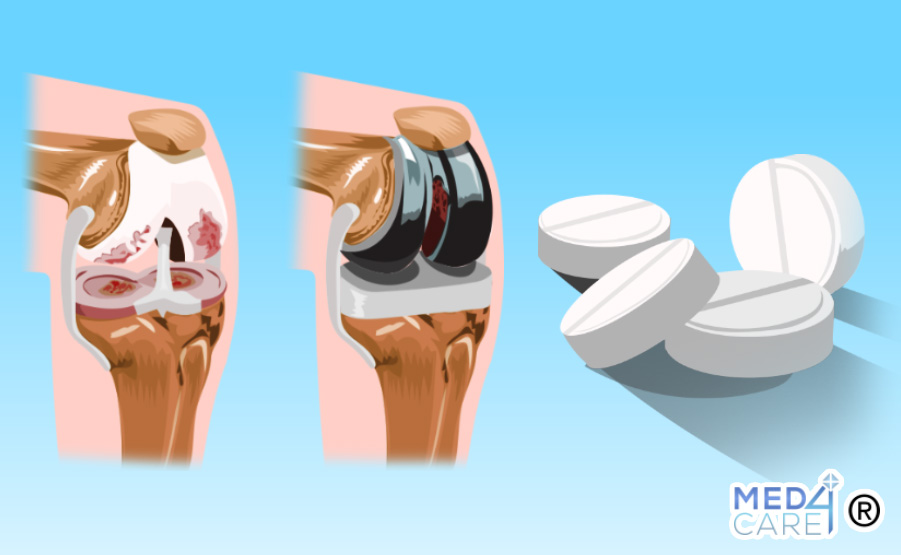 Aspirina per tromboprofilassi dopo artroplastica al ginocchio