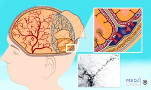 Scopri di più sull'articolo L’embolizzazione dell’arteria meningea media nella gestione dell’ematoma subdurale cronico