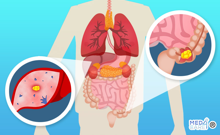 Epatectomia o chemioterapia per le metastasi del colon-retto, metastasi colon-retto