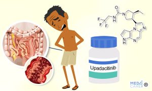 Scopri di più sull'articolo L’immunosoppressore Upadacitinib è efficace nella remissione clinica del morbo di Crohn