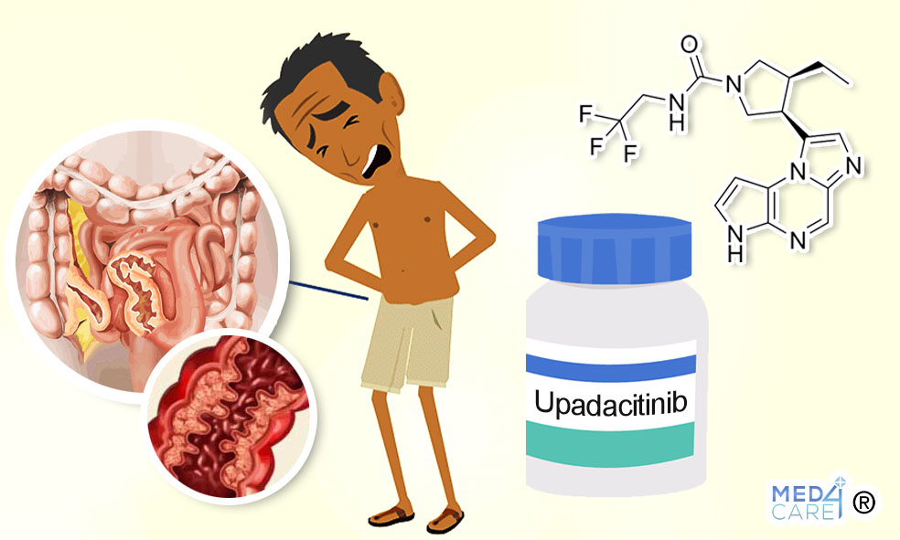 Upadacitinib e morbo di Crohn, malattia di Crohn