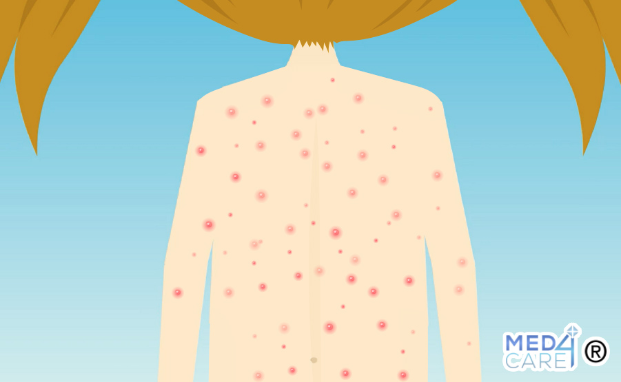 pitiriasi rosea, eruzione cutanea del virus HHV-6 e HHV-7