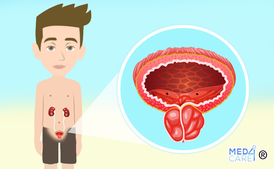 Prostatite, infezioni della prostata, infiammazione prostata, infezioni apparato genitale maschile