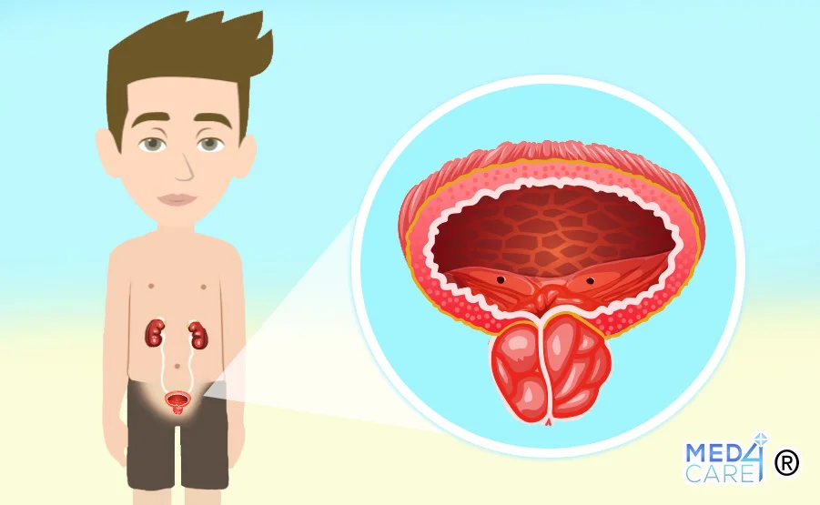 Prostatite, infezioni della prostata, infiammazione prostata, infezioni apparato genitale maschile