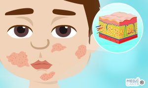 Scopri di più sull'articolo Quanto influisce l’assetto lipidico del sebo nella patogenesi della dermatite atopica?