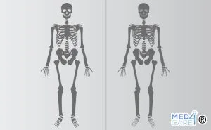 Scintigrafia ossea, esame di imaging per le ossa