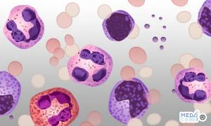 Scopri di più sull'articolo Eosinofili alti o eosinofilia