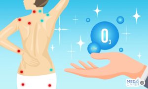 Scopri di più sull'articolo Ozonoterapia per la fibromialgia