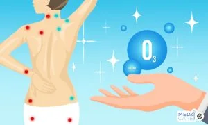 Scopri di più sull'articolo Ozonoterapia per la fibromialgia