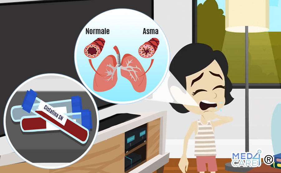 Asma allergica e cistatina SN, asma