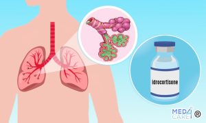 Scopri di più sull'articolo Polmonite acquisita in comunità grave: è ora di legittimare l’uso dell’idrocortisone?