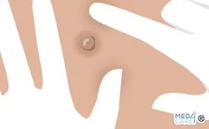Scopri di più sull'articolo Cisti sebacea