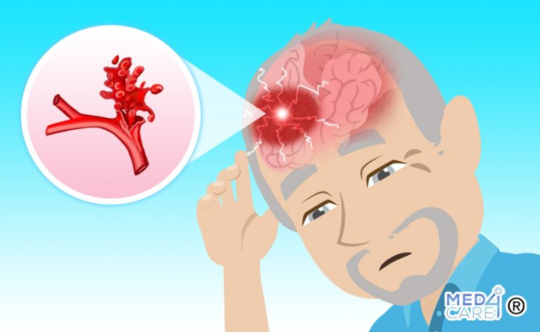 Differenza Tra Ictus E Emorragia Cerebrale Emorragia cerebrale o ictus emorragico - Med4Care