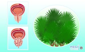 Scopri di più sull'articolo Estratto di Serenoa repens nel trattamento dell’iperplasia prostatica benigna: efficacia e sicurezza