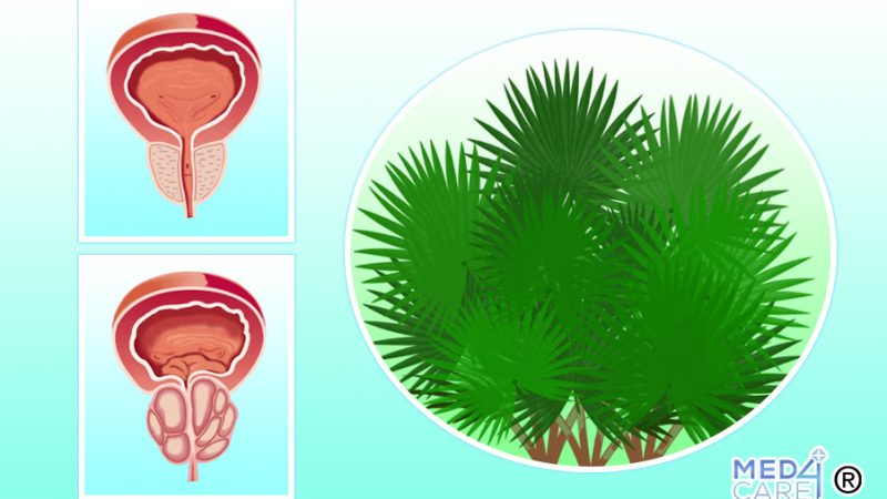 Serenoa e iperplasia prostatica benigna, Serenoa repens, iperplasia prostatica benigna