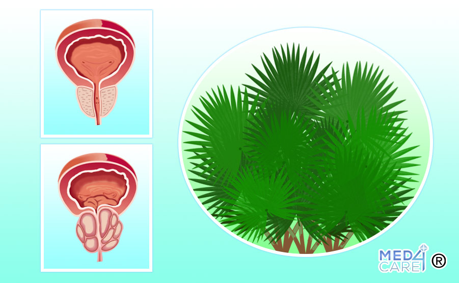 Serenoa e iperplasia prostatica benigna, Serenoa repens, iperplasia prostatica benigna