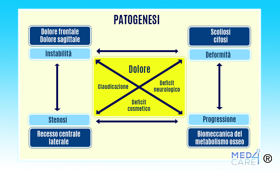 Patogenesi della scoliosi, sintomi e progressione