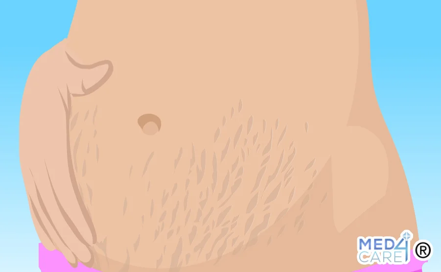 Smagliature