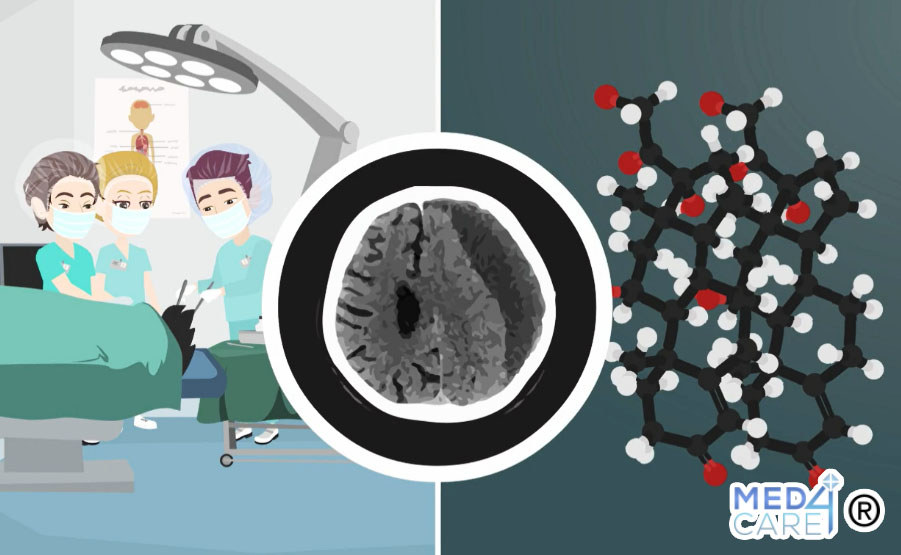 Trattamento dell’ematoma subdurale cronico, ematoma subdurale cronico, chirurgia, glucocorticoidi