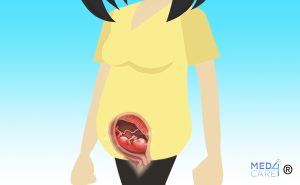 utero retroverso, gravidanza