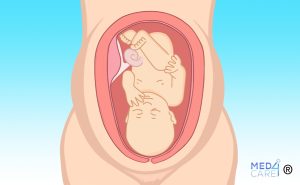 utero retroverso, gravidanza