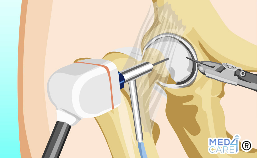 artroscopia dell'anca, artroscopia, anca, procedure