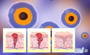 Scopri di più sull'articolo Gli esosomi delle cellule staminali promuovono il processo di guarigione delle ferite?