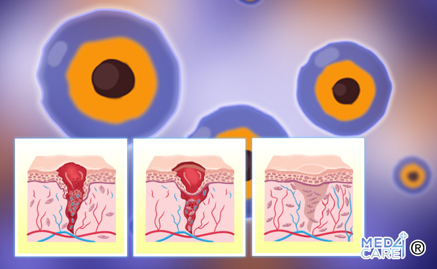 Cellule staminali e guarigione delle ferite