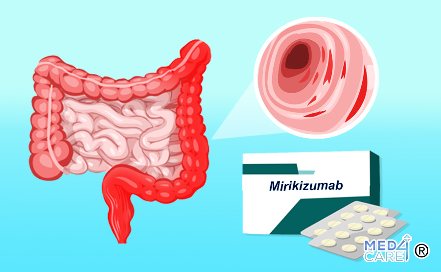 Colite ulcerosa e Mirikizumab, trattamento della colite ulcerosa, farmaco Mirikizumab