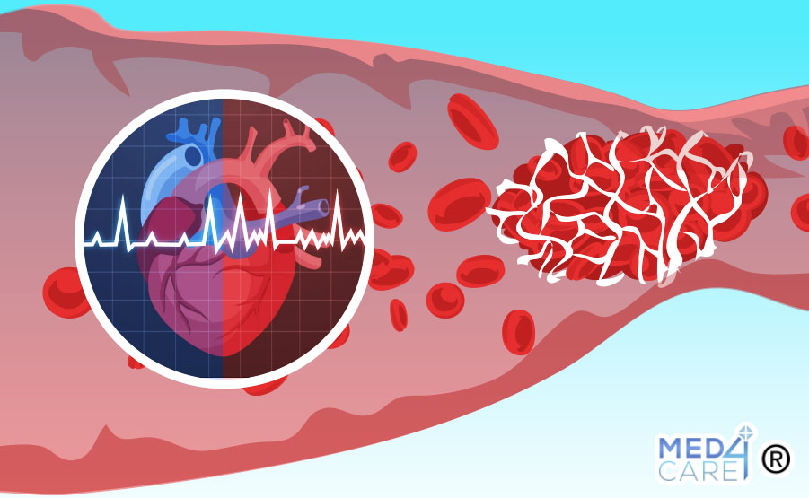 FA e ictus ischemico terapia anticoagulante, fibrillazione atriale, ictus