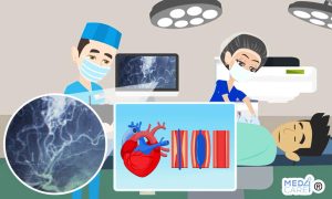 Scopri di più sull'articolo L’intervento coronarico percutaneo produce meno rischi se guidato dall’imaging intravascolare o dall’angiografia?