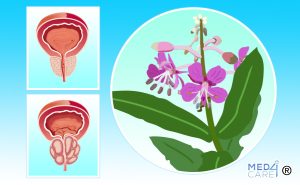 Scopri di più sull'articolo Valutazione degli effetti terapeutici dei costituenti attivi dell’Epilobio contro l’iperplasia prostatica benigna