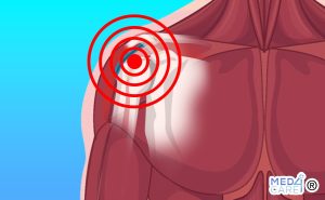 Scopri di più sull'articolo Sindrome da impingement subacromiale o sindrome da conflitto acromiale
