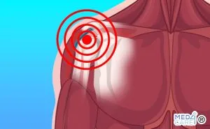 Scopri di più sull'articolo Sindrome da impingement subacromiale o sindrome da conflitto acromiale