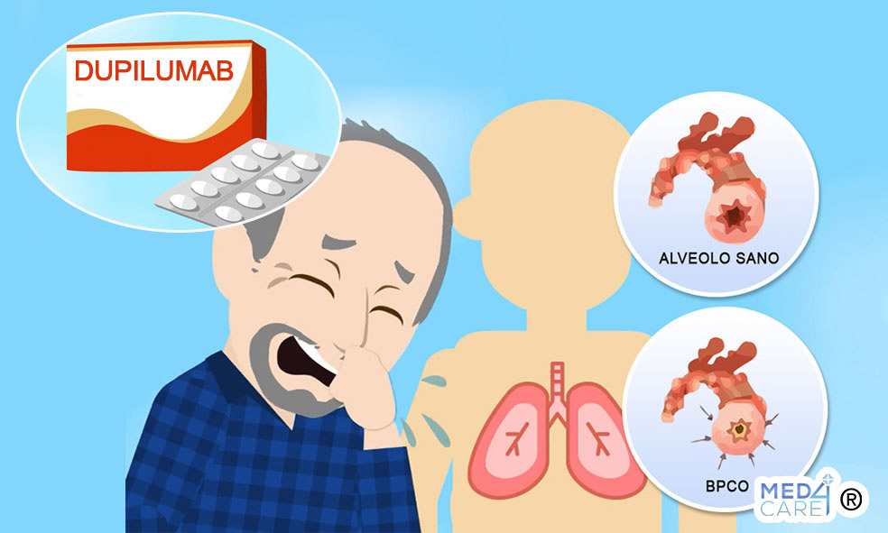 Dupilumab e BPCO, Dupilumab, BPCO, cura della BPCO, trattamento della BPCO