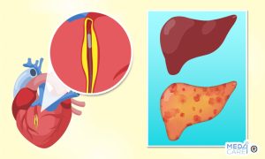 Scopri di più sull'articolo I pazienti infartuati affetti da NAFLD sono a maggior rischio di nuove complicazioni cardiovascolari dopo l’intervento coronarico?