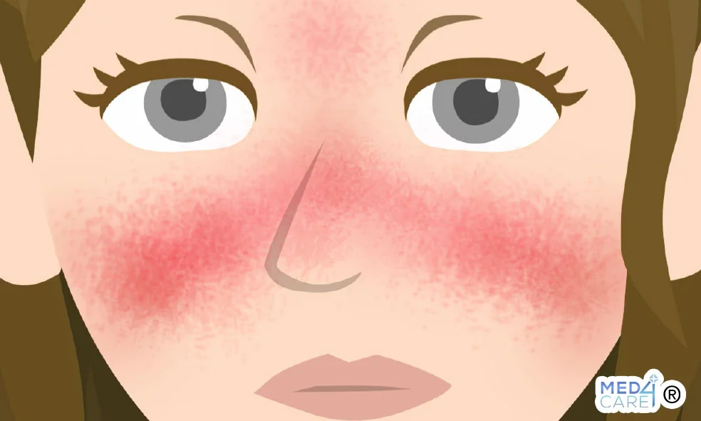Disbiosi e LEs, lupus eritematoso sistemico, LES, disbiosi, disbiosi intestinale