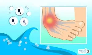 Scopri di più sull'articolo L’idroterapia con acqua idrogenata nel trattamento della distorsione di caviglia